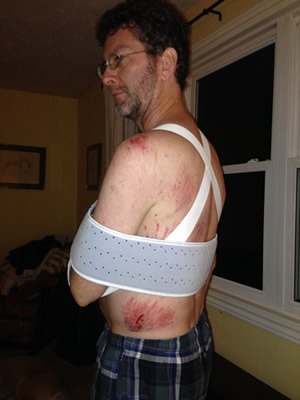 Rob following the bike crash